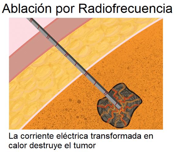 Ablación por radiofrecuencia (RFA)