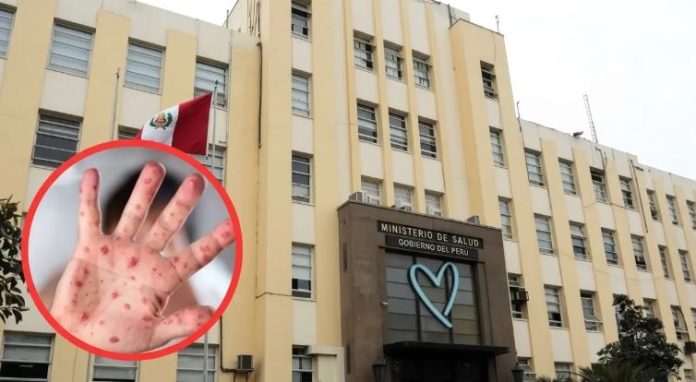 Minsa debe ponerse pilas y evitar brote de sarampión