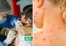 contagios de sarampión