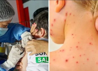 contagios de sarampión