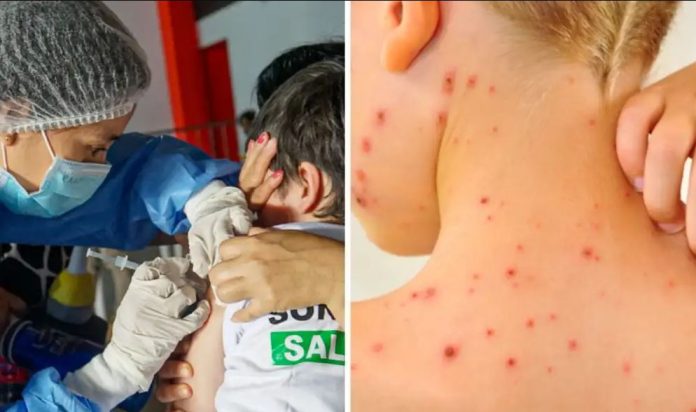 contagios de sarampión