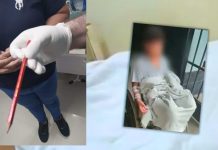 Perforan intestino a escolar de 11 años